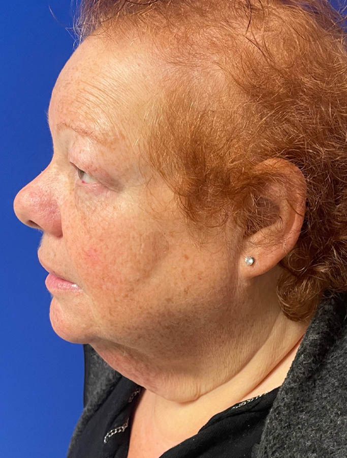 Before Image: Patient Case #18104 - left-side