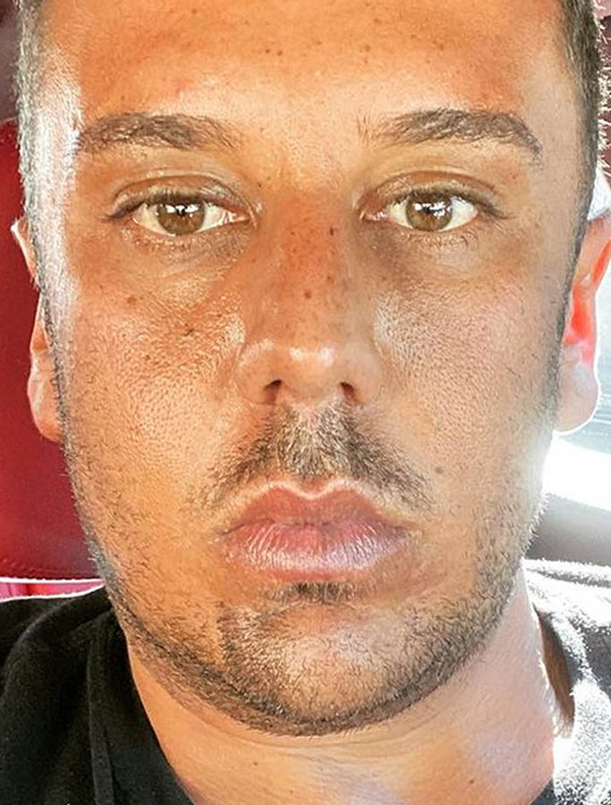 Before Image: Patient Case #18112 - front