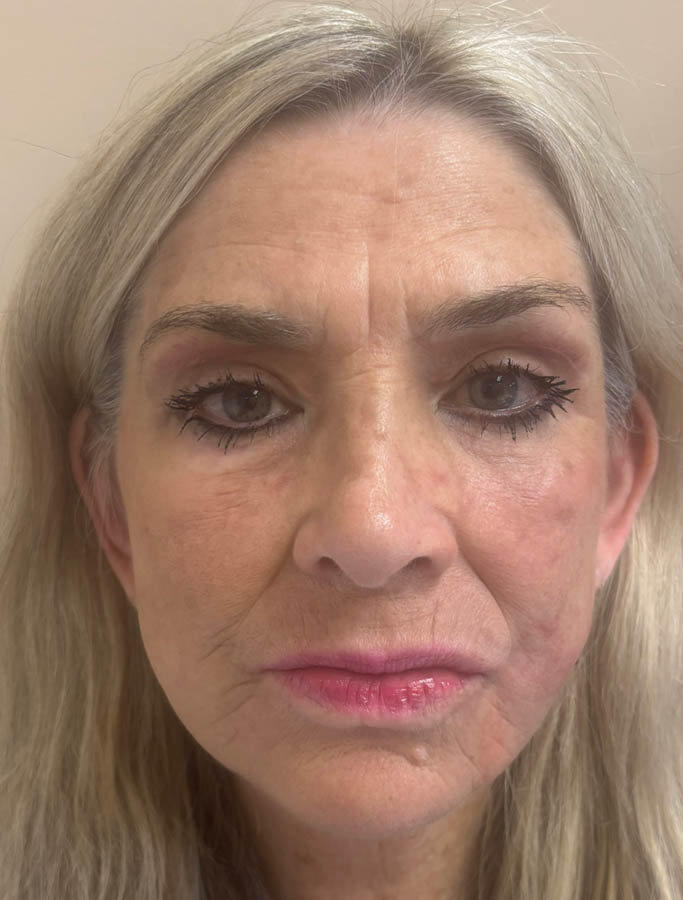 After Image: Patient Case #18907 - front