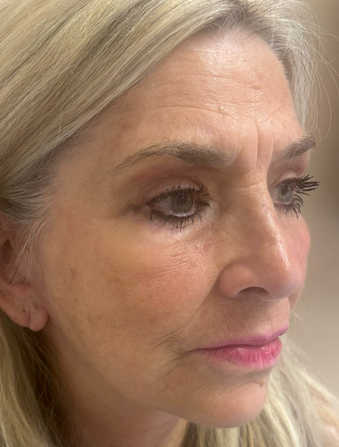 After Image: Patient Case #18907 - right-front-oblique