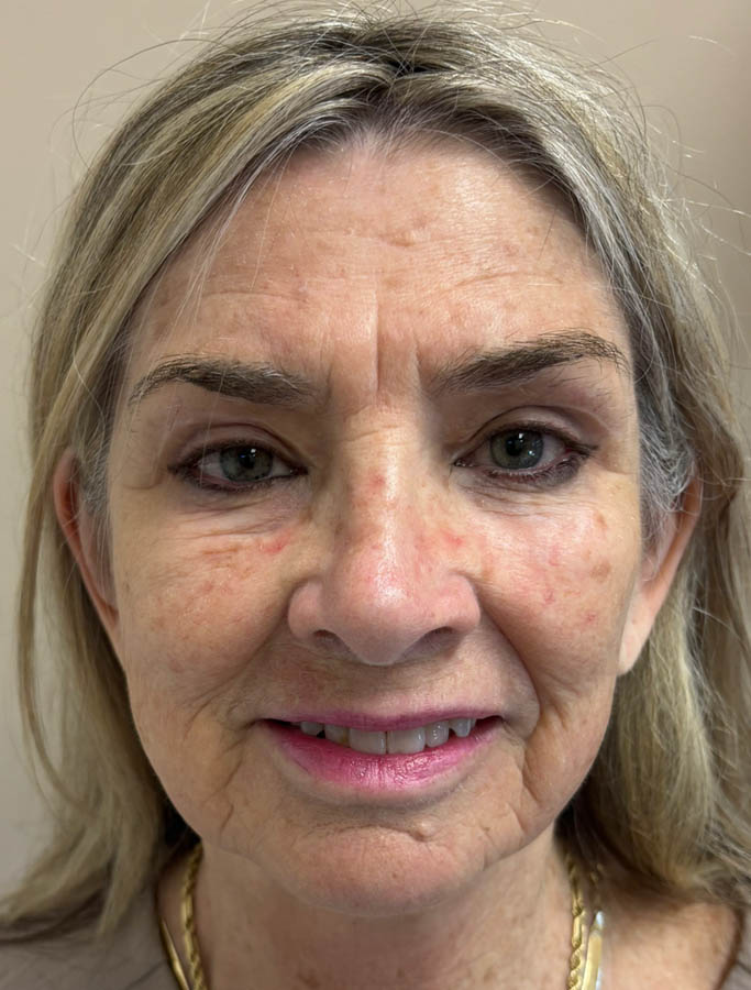 Before Image: Patient Case #18907 - front