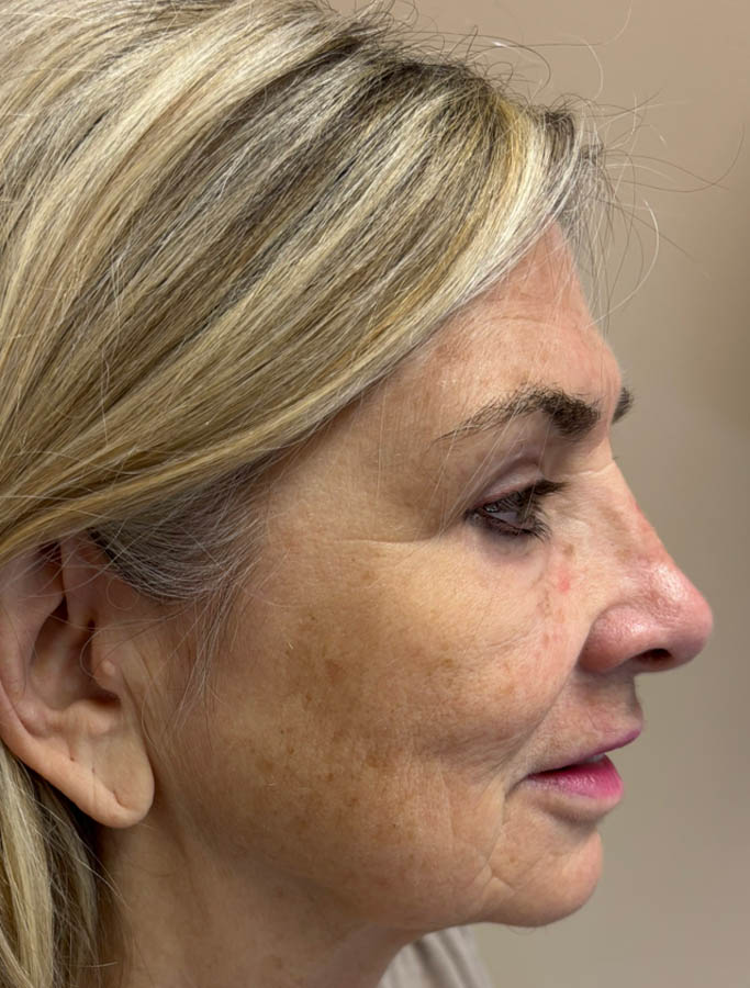 Before Image: Patient Case #18907 - right-side