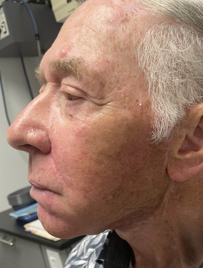 After Image: Patient Case #18109 - left-side