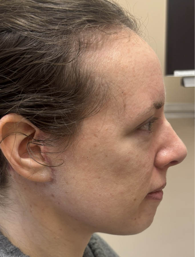 After Image: Patient Case #18613 - right-side