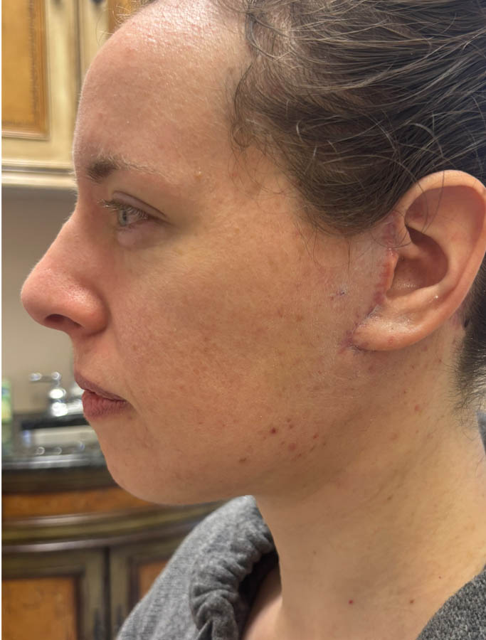 After Image: Patient Case #18613 - left-side