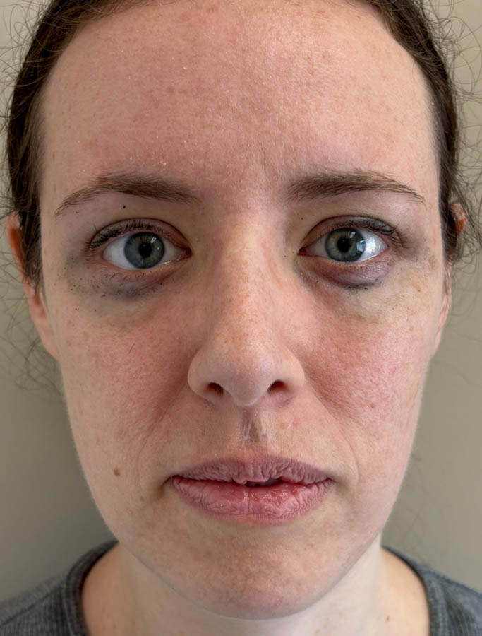 Before Image: Patient Case #18613 - front