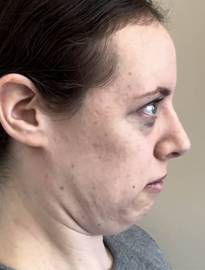 Before Image: Patient Case #18613 - right-side