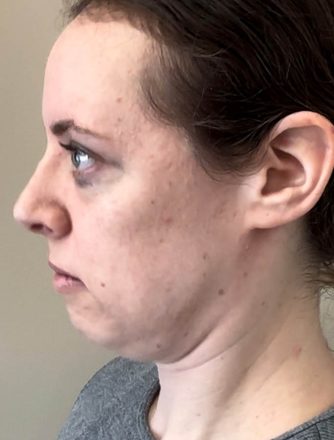 Before Image: Patient Case #18613 - left-side