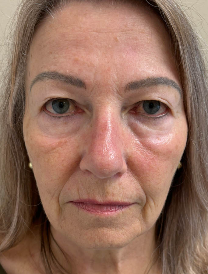 Before Image: Patient Case #18636 - front