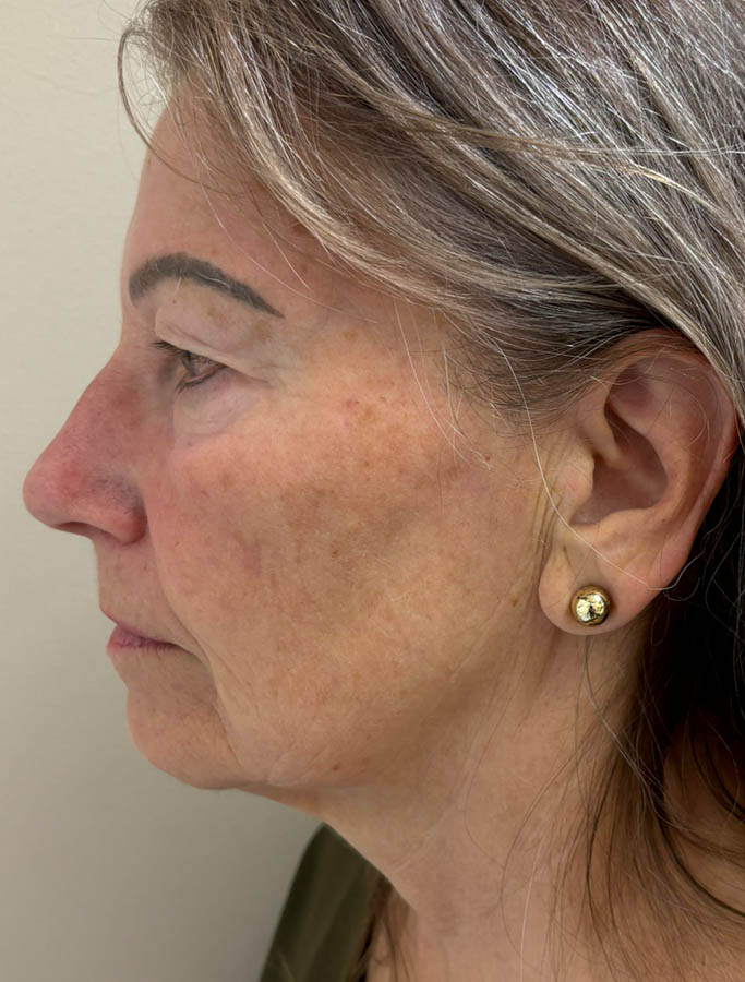 Before Image: Patient Case #18636 - left-side