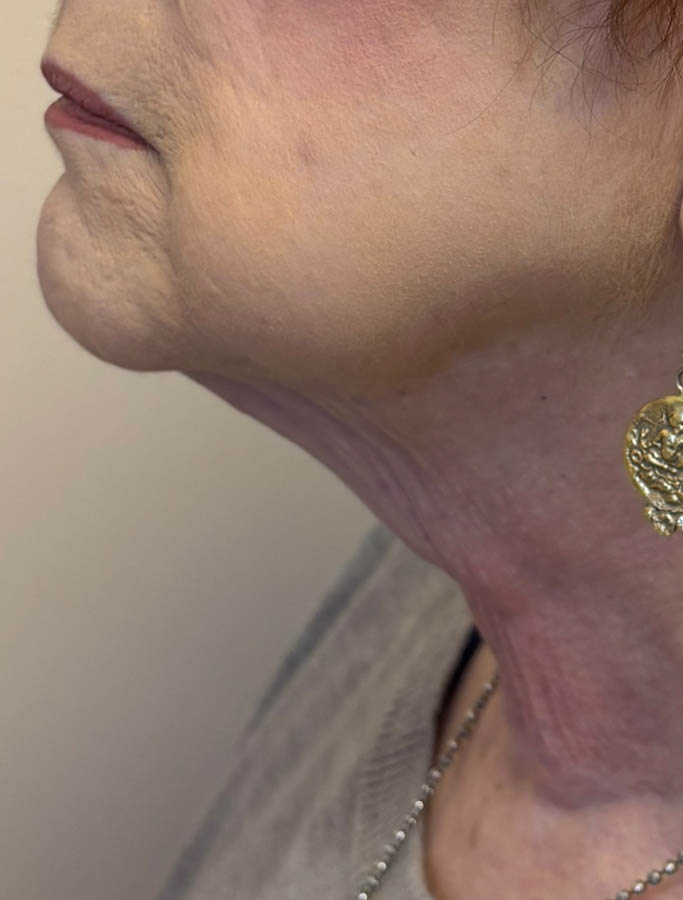 Before Image: Patient Case #18643 - left-side