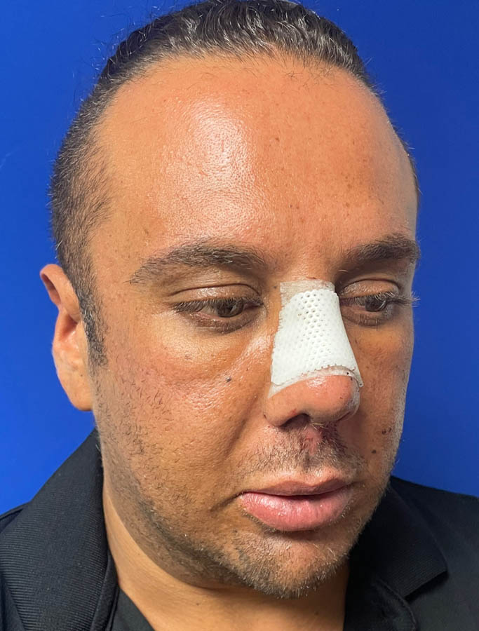 Before Image: Patient Case #18904 - right-front-oblique