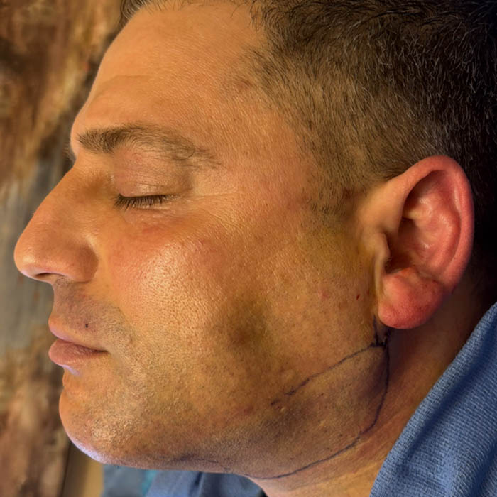 After Image: Patient Case #18559 - left-side