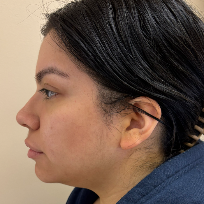 Before Image: Patient Case #18564 - left-side