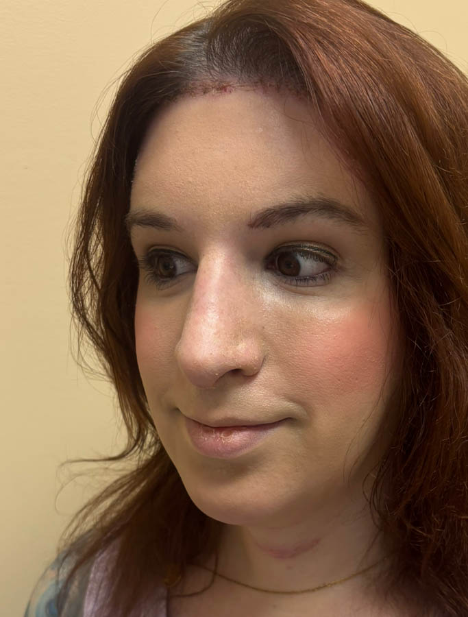 After Image: Patient Case #18917 - left-front-oblique