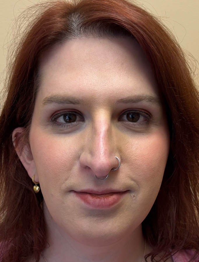 Before Image: Patient Case #18917 - front