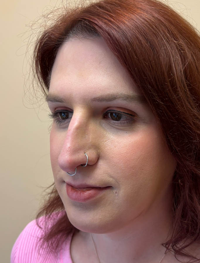 Before Image: Patient Case #18917 - left-front-oblique