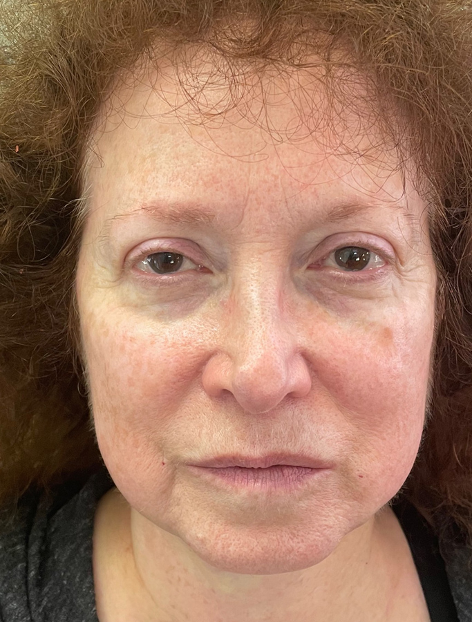 Before Image: Patient Case #1621 - front