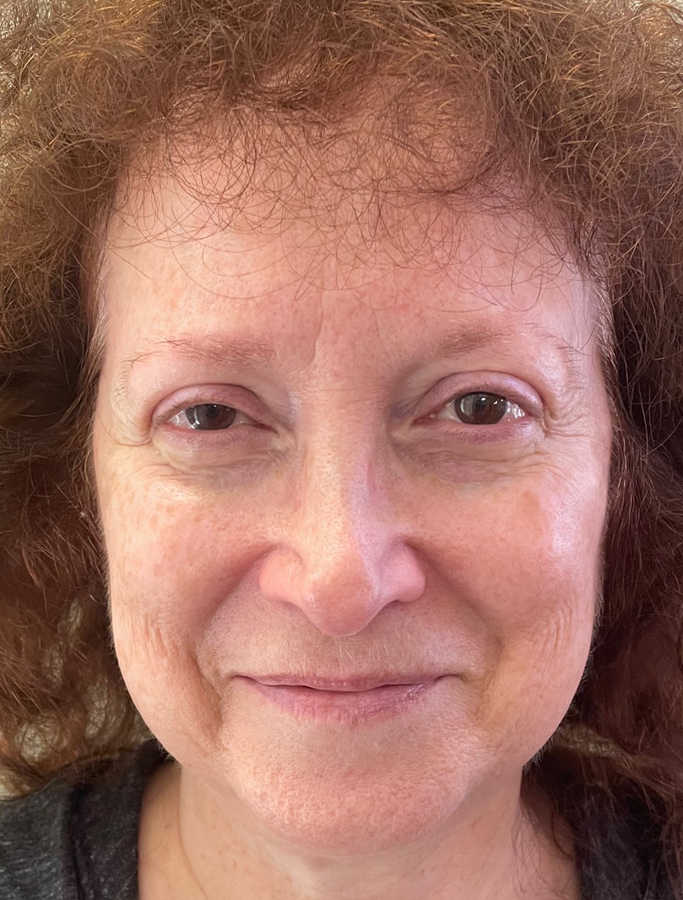 Before Image: Patient Case #1621 - front