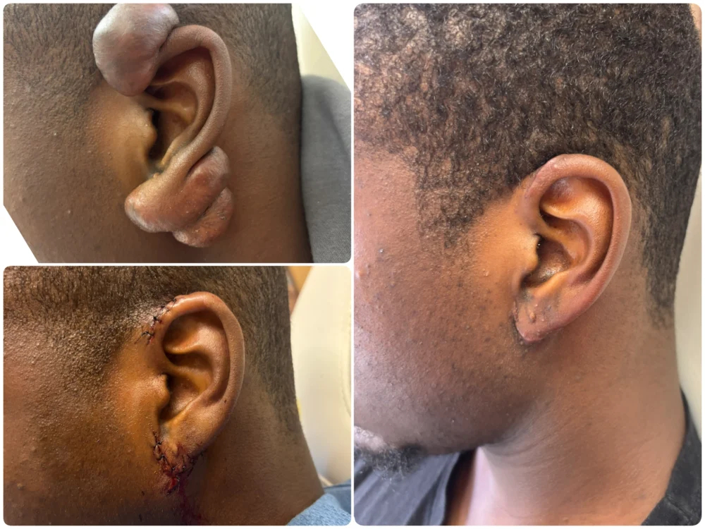 Before Image: Patient Case #18587 - left-side