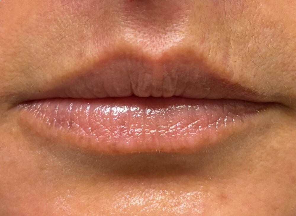 After Image: Patient Case #17818 - front