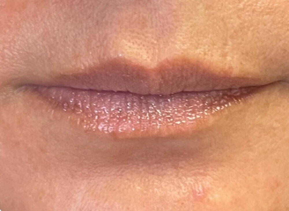 Before Image: Patient Case #17818 - front