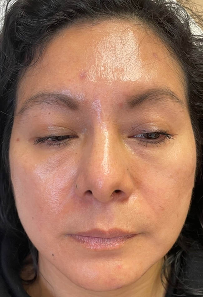 Before Image: Patient Case #17818 - front