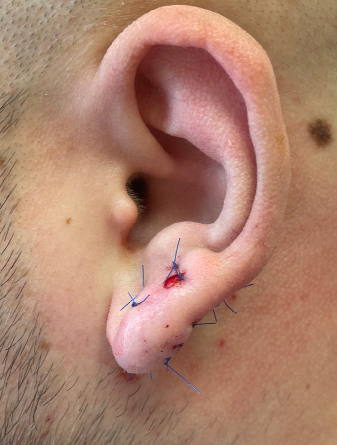 After Image: Patient Case #1626 - left-side
