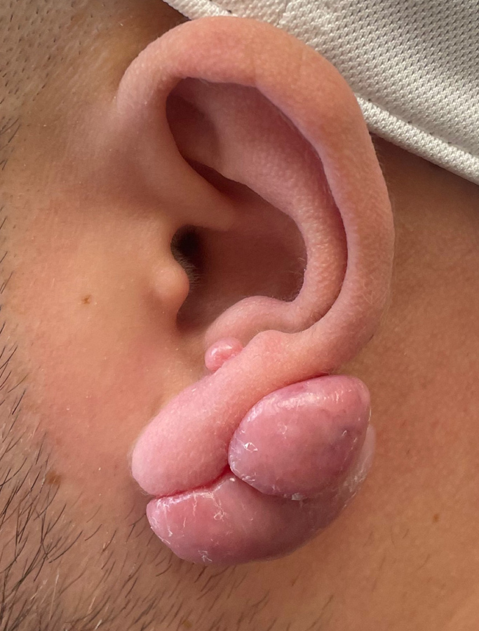 Before Image: Patient Case #1626 - left-side