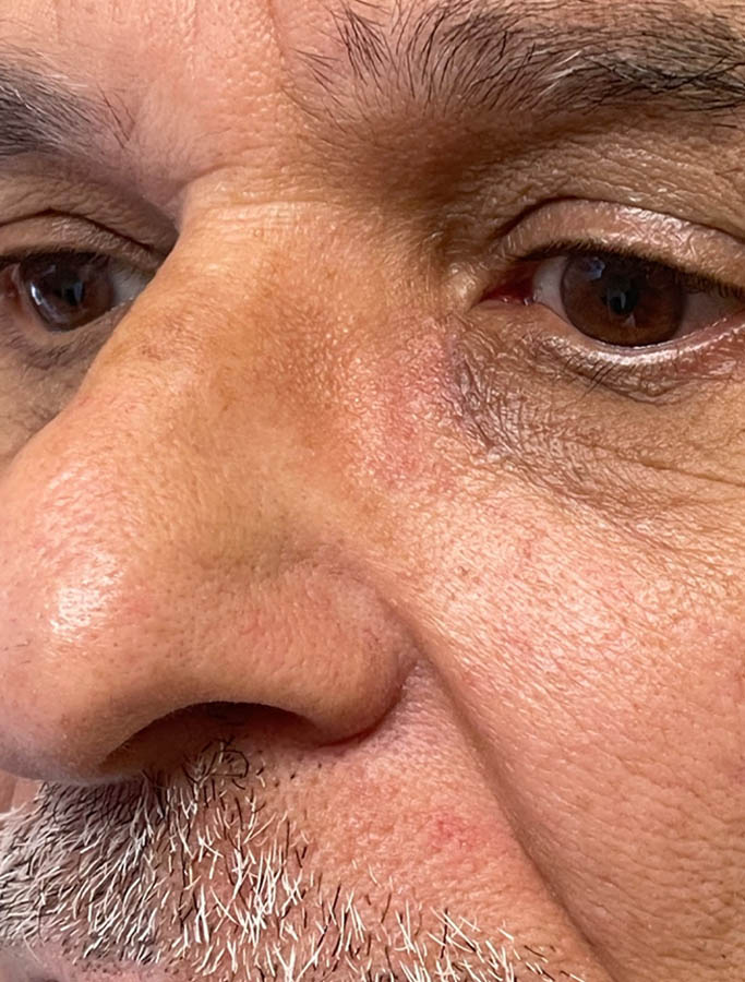 After Image: Patient Case #17909 - left-front-oblique