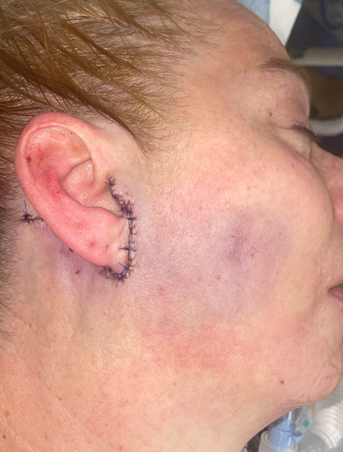 After Image: Patient Case #17912 - right-side