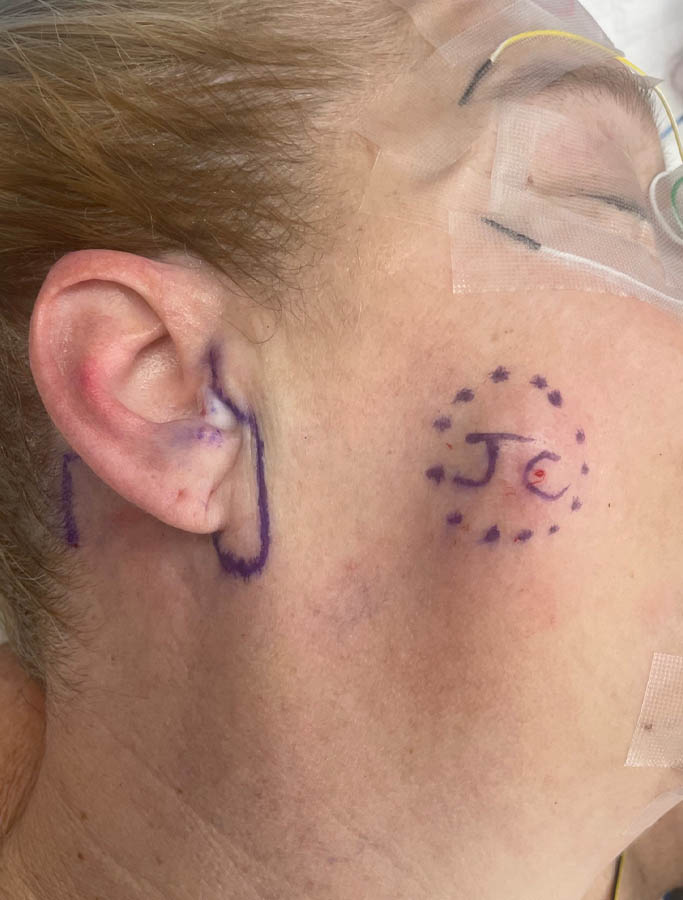 Before Image: Patient Case #17912 - right-side