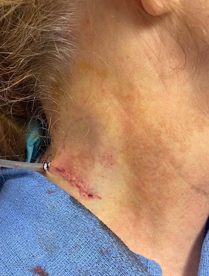 After Image: Patient Case #17915 - right-side