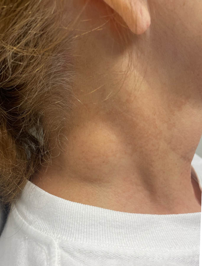 Before Image: Patient Case #17915 - right-side