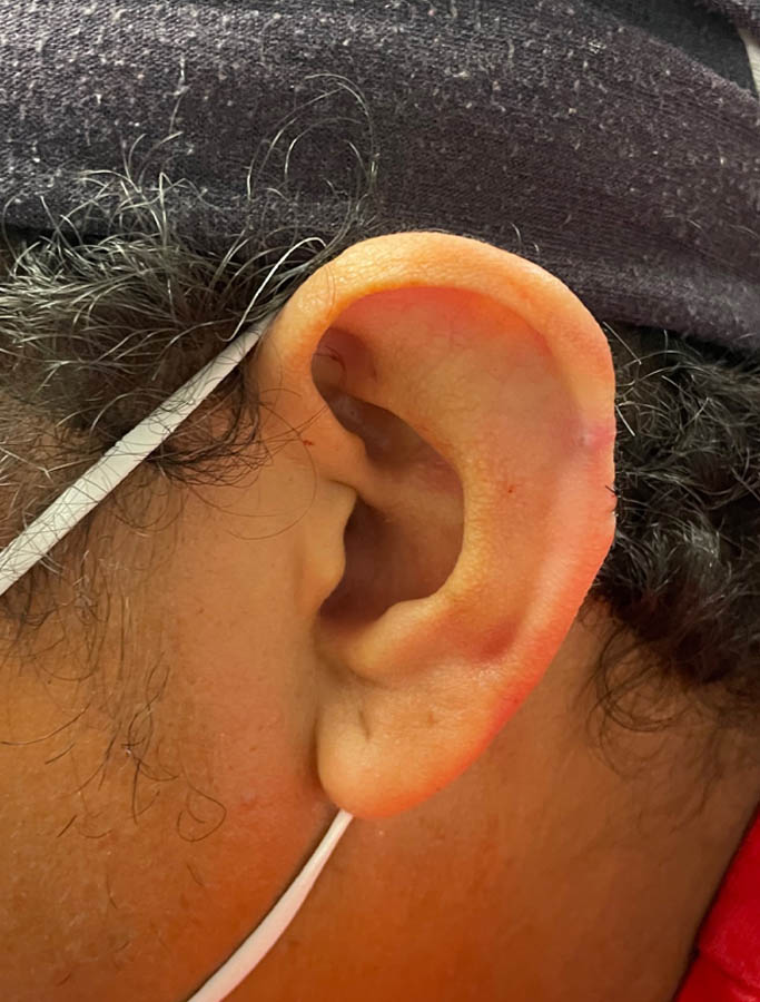 After Image: Patient Case #17918 - left-side