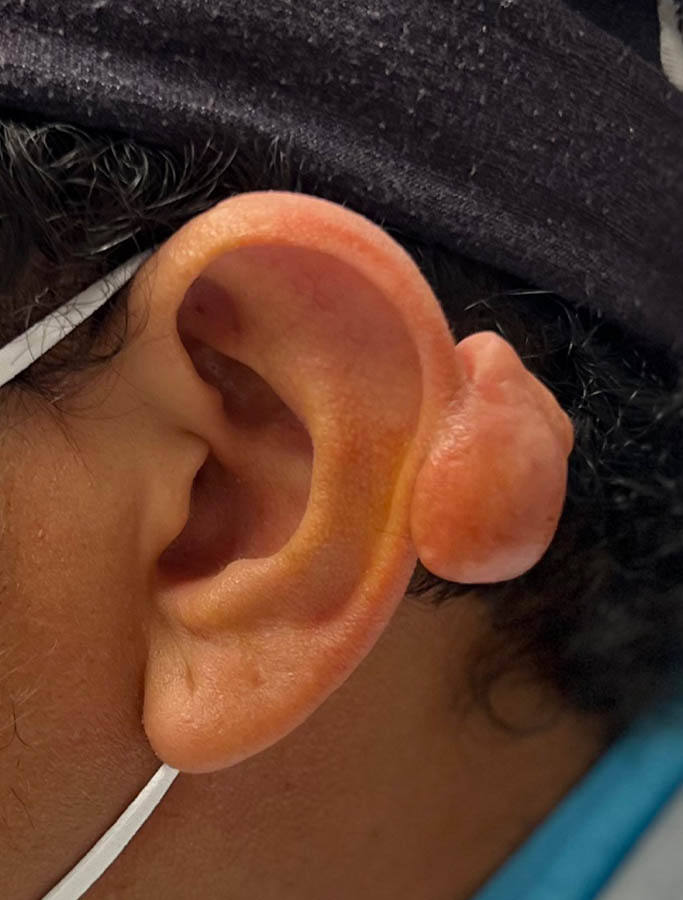 Before Image: Patient Case #17918 - left-side