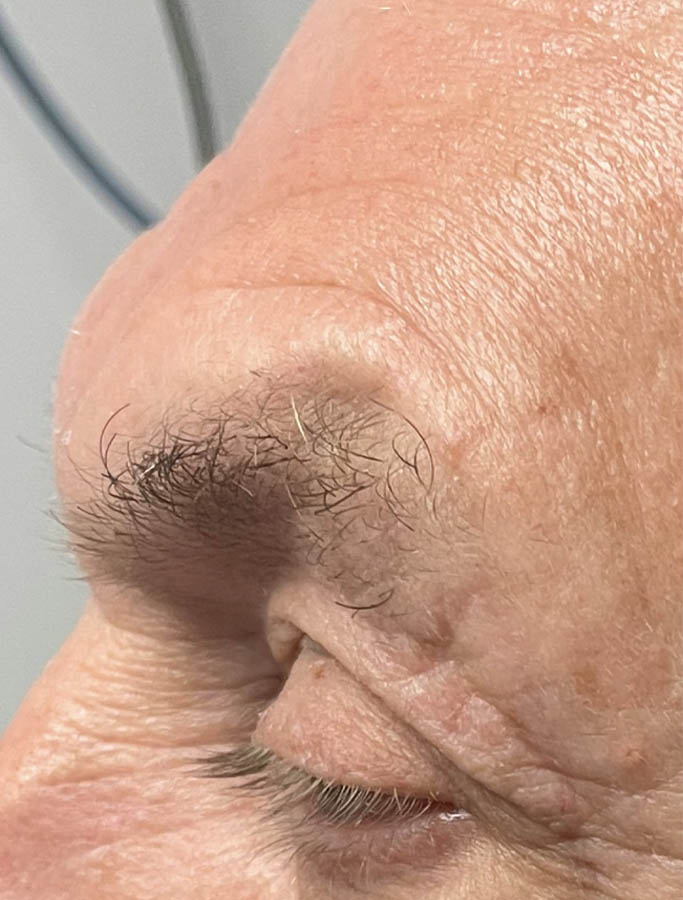 After Image: Patient Case #17921 - left-side