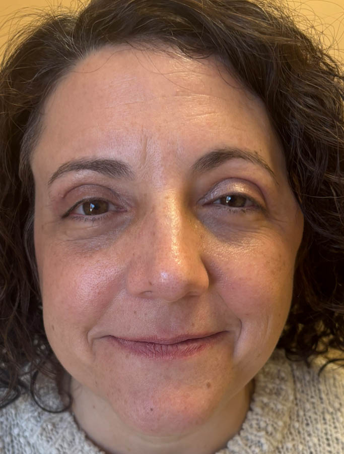 After Image: Patient Case #18573 - front