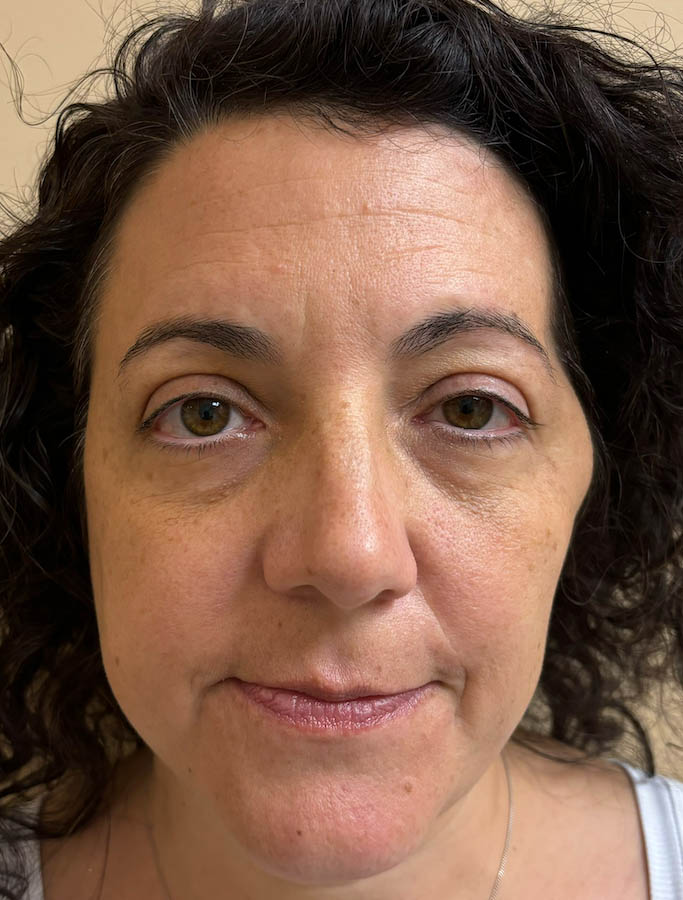 Before Image: Patient Case #18573 - front