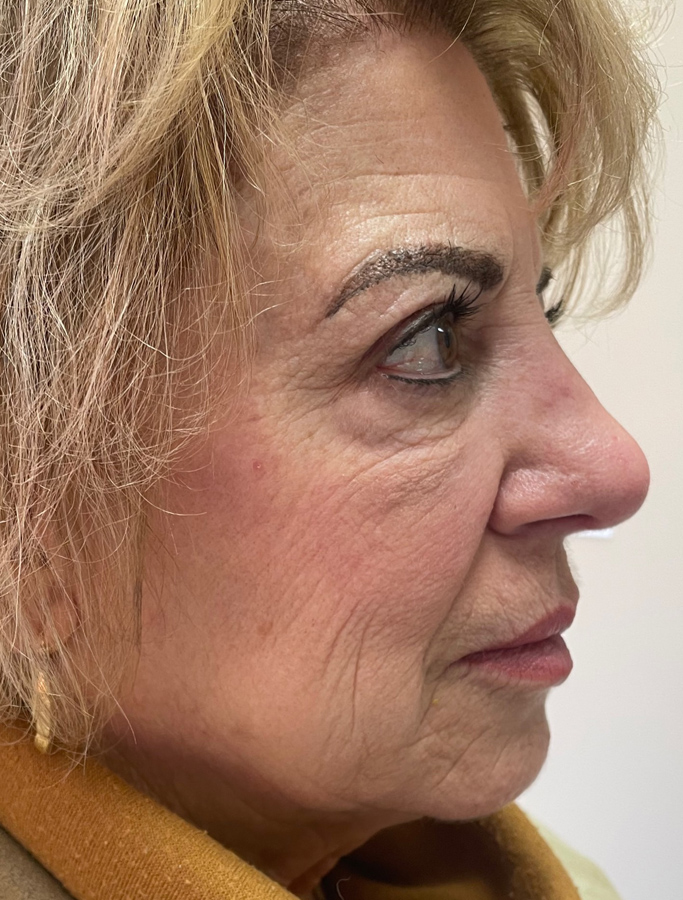 After Image: Patient Case #1637 - right-side