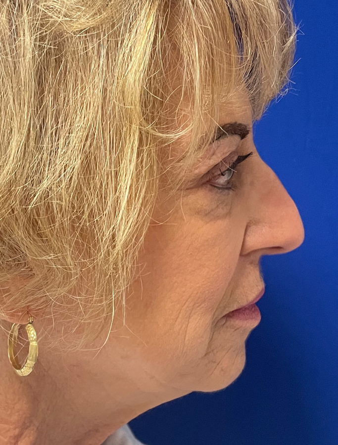 Before Image: Patient Case #1637 - right-side