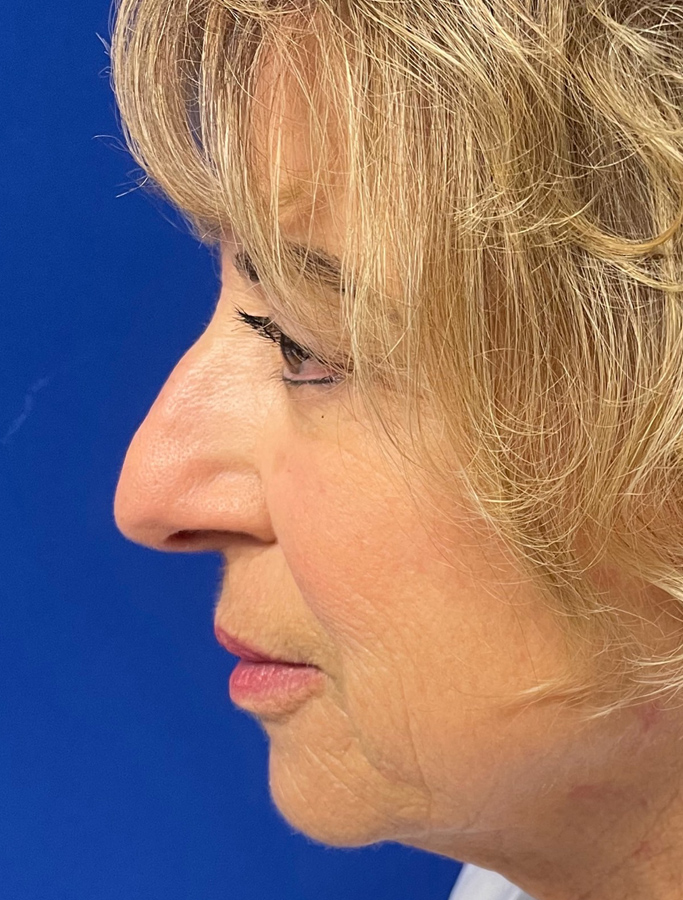 Before Image: Patient Case #1637 - left-side