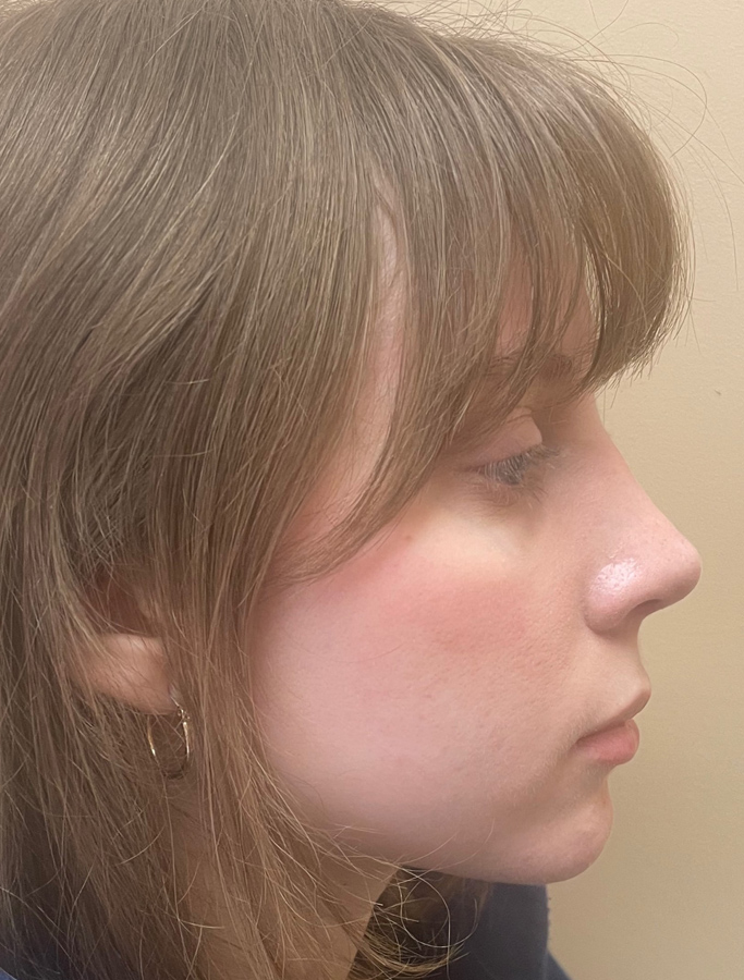 After Image: Patient Case #1668 - right-side