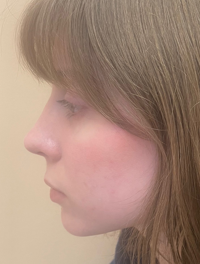 After Image: Patient Case #1668 - left-side