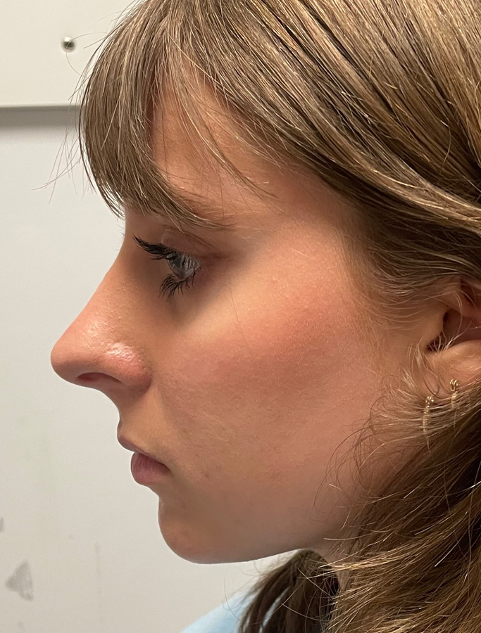 Before Image: Patient Case #1668 - left-side