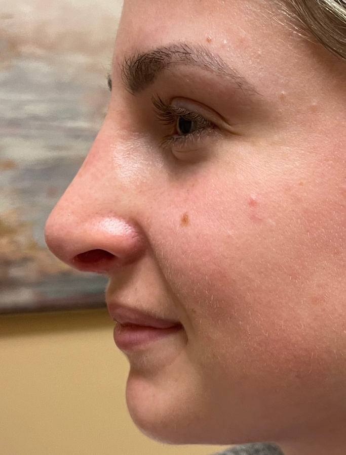 After Image: Patient Case #1669 - left-side