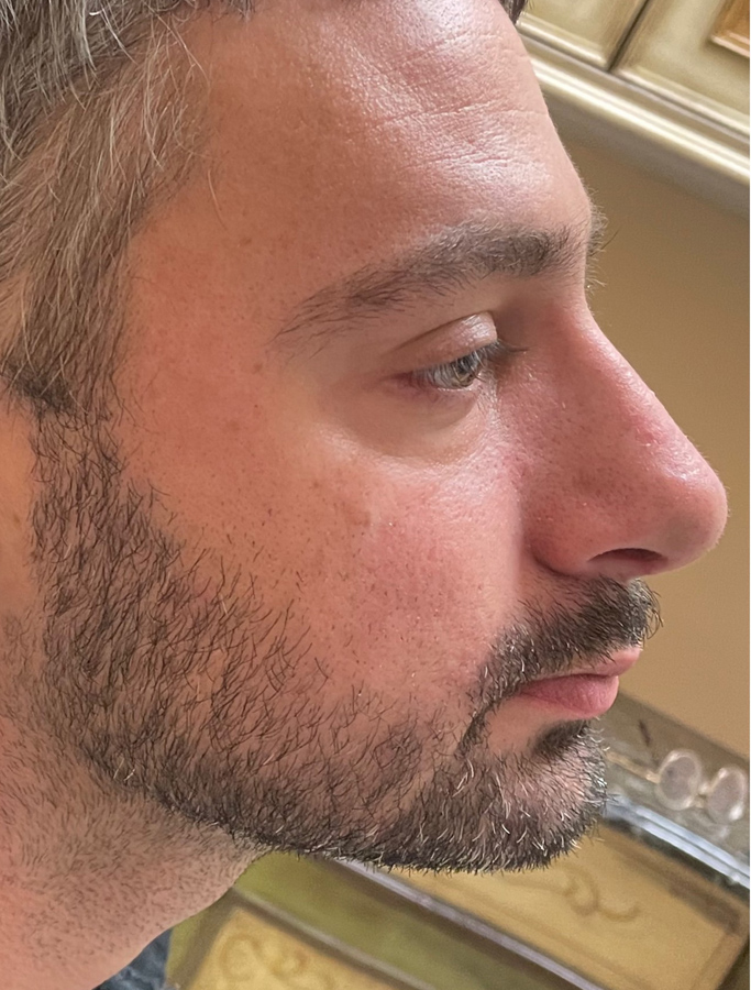 After Image: Patient Case #1670 - right-side