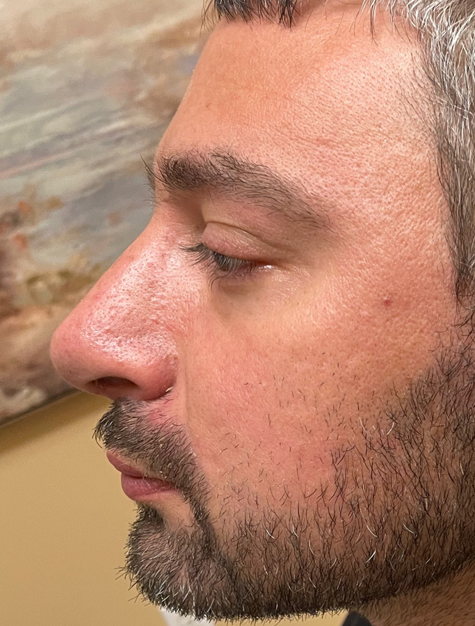 After Image: Patient Case #1670 - left-side