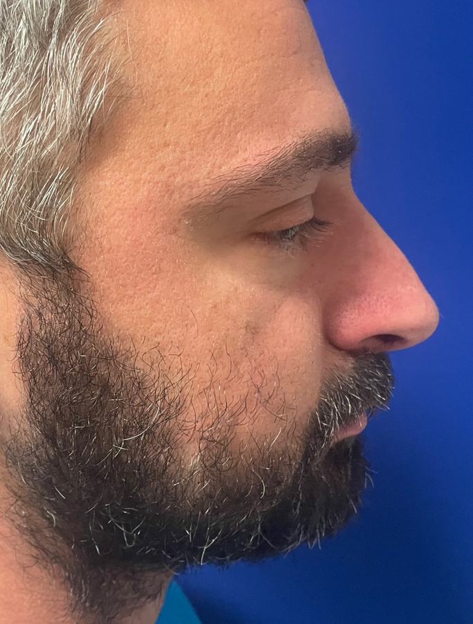 Before Image: Patient Case #1670 - right-side