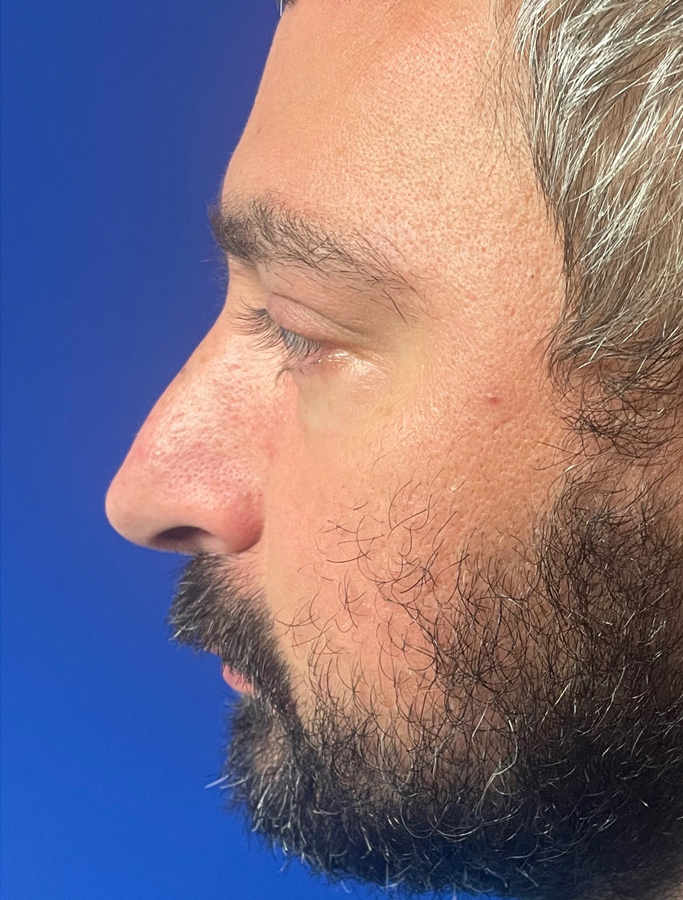 Before Image: Patient Case #1670 - left-side